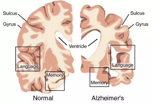 AD药物研发现状：辉瑞、礼来、百健、诺华、强生……