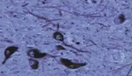 正常人：黑质神经元存在