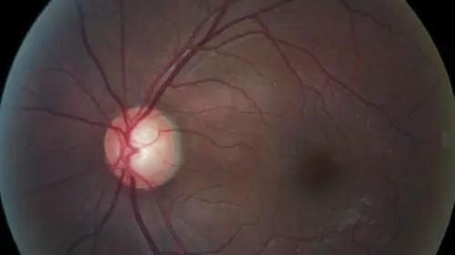 青光眼的克星来袭，助力患者远离视力的“窃贼”