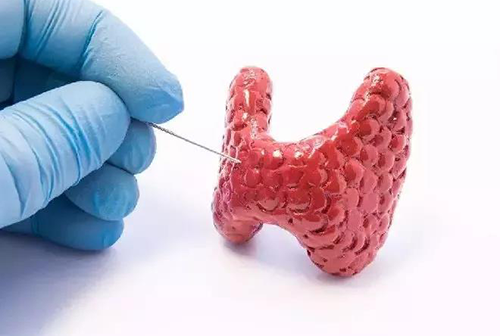 甲状腺疾。鬃聪俟δ芗跬撕图鬃聪俟δ芸航，自古以来就是反复被医学研究人员研究的疾病