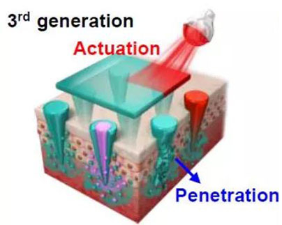 第三代：通过微针介导的皮肤层破坏和微针伴随的各种功能增强药物转运.jpg