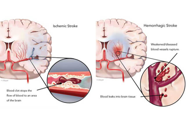 世界卒中日：从动物药效模型评价看心脑血管药物开发